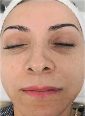 After AquaFirme treatment