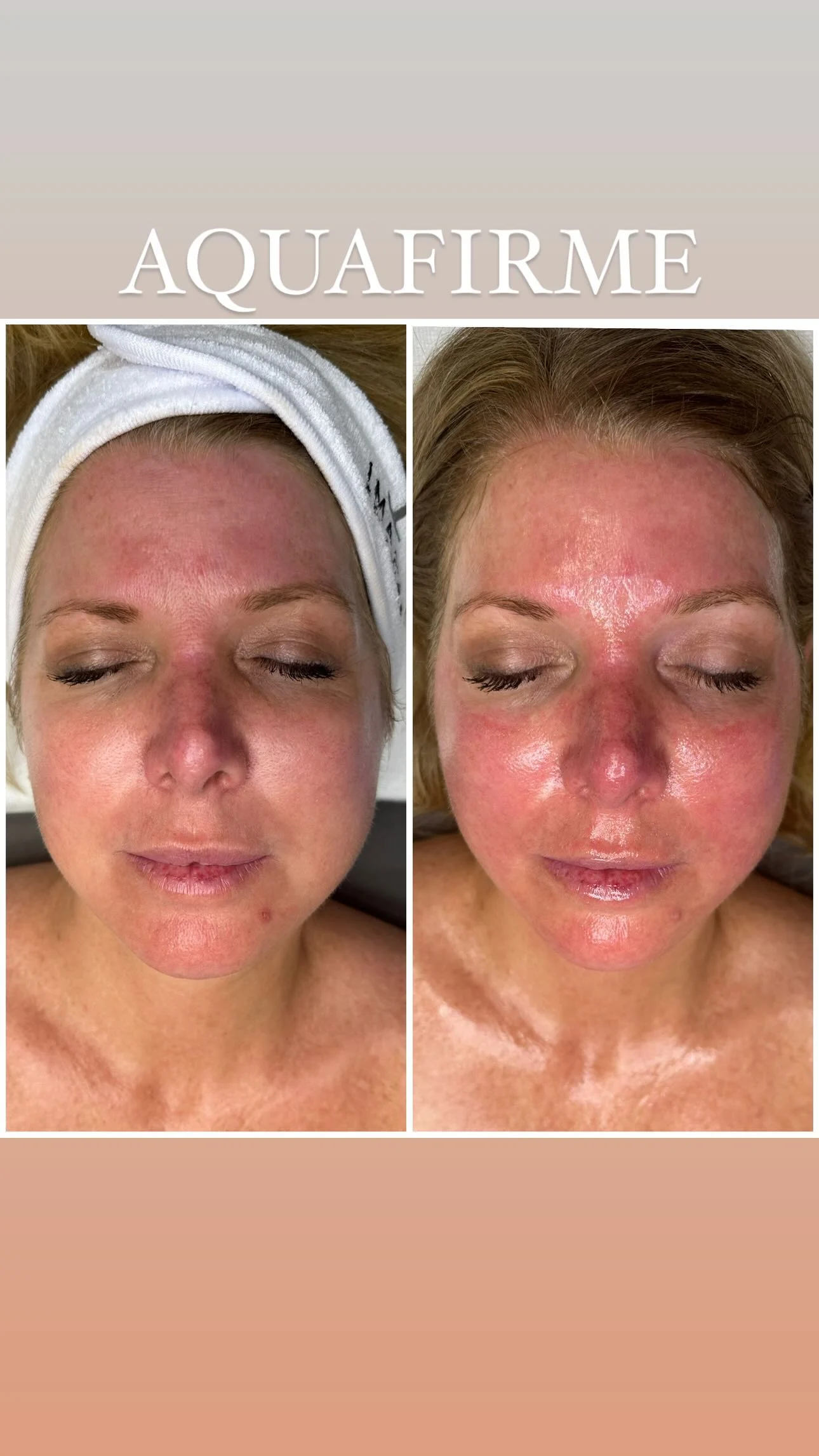 AquaFirme before and after result