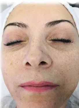 Before AquaFirme treatment