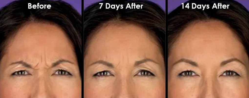 Botox before and after results