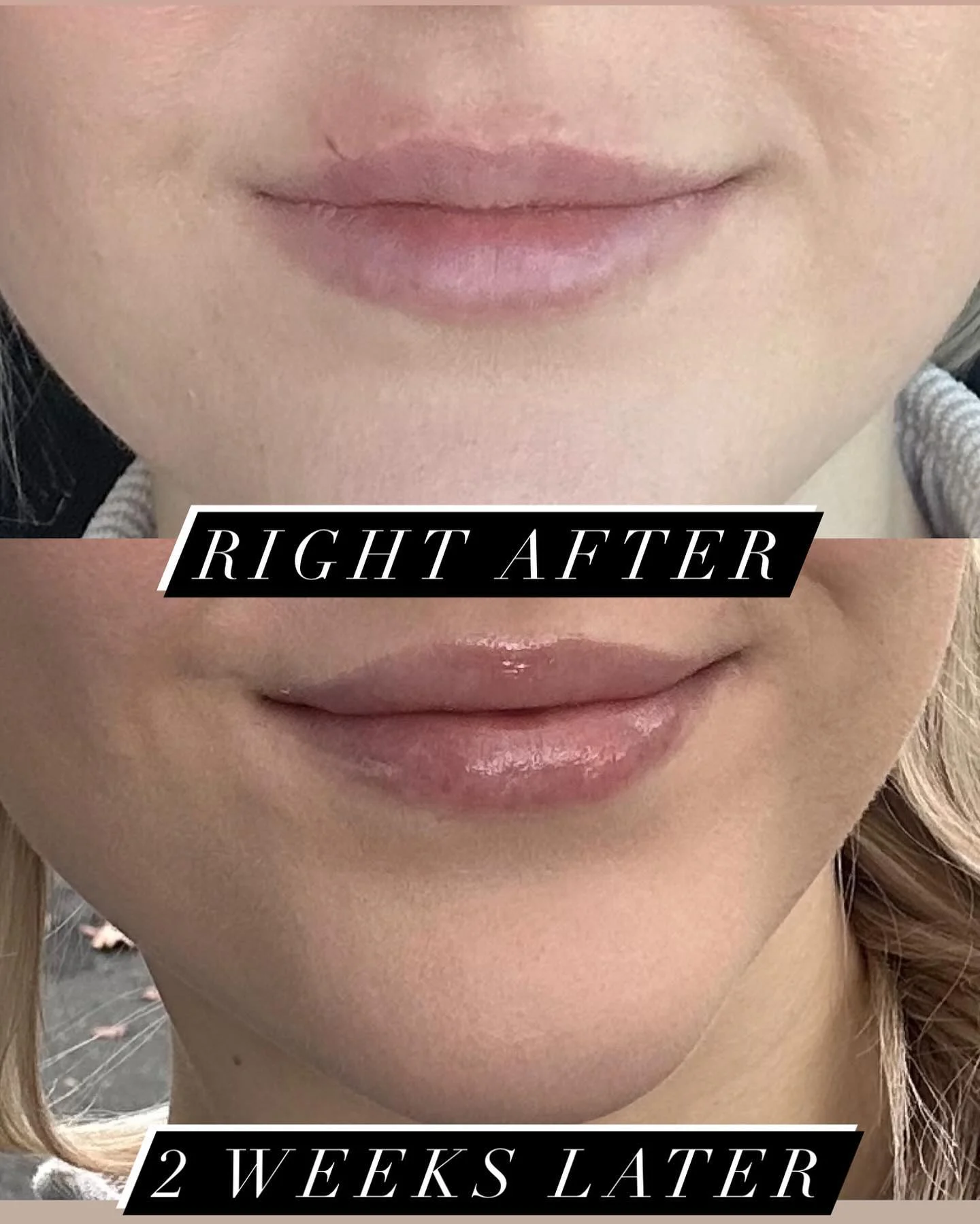 Lip Flip before and after result