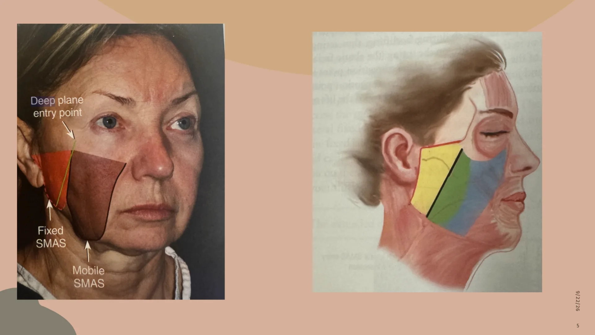 Photo and drawing of the cheek showing the deep plane entry point between the fixed and mobile SMAS