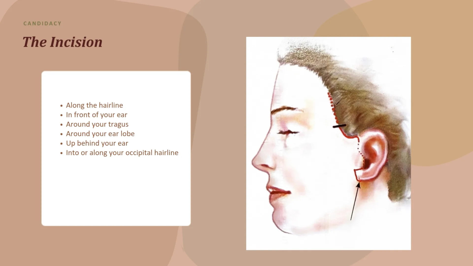 Drawing of the incision path along the hairline, in front of and around the ear, and into the hairline behind it