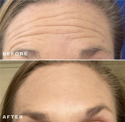 Botox® & Dysport® promotion