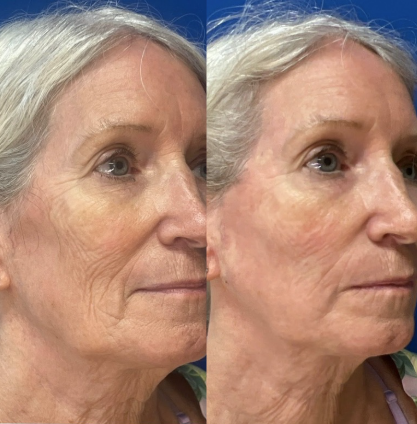 Sculptra® promotion