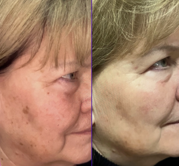 Icon IPL Treatment promotion