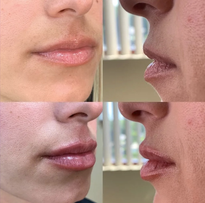 Kyssable Lips with Restylane Kysse promotion