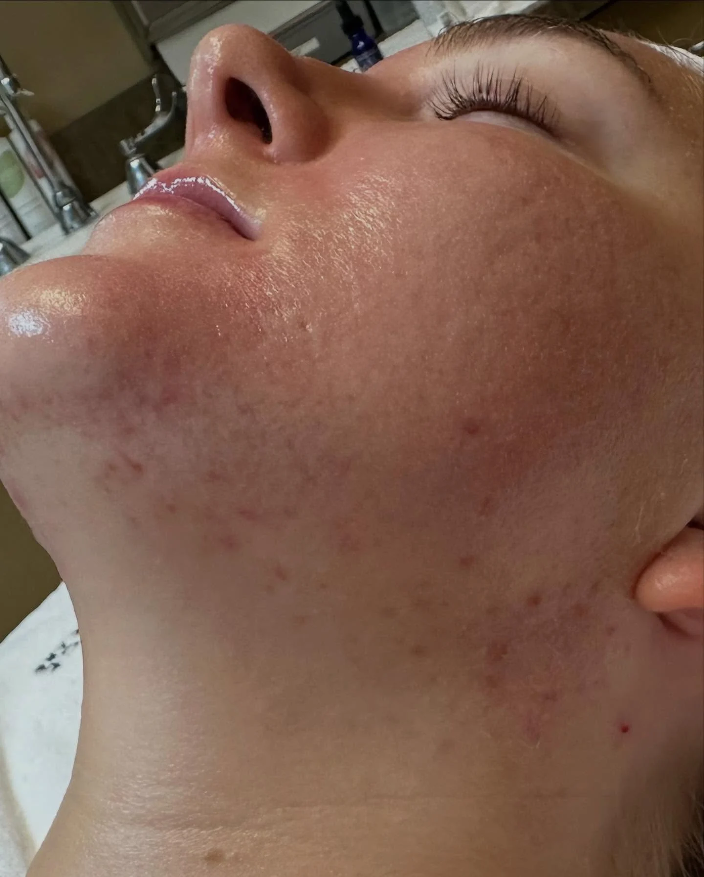 Clearer, calmer skin after a chemical peel series for acne