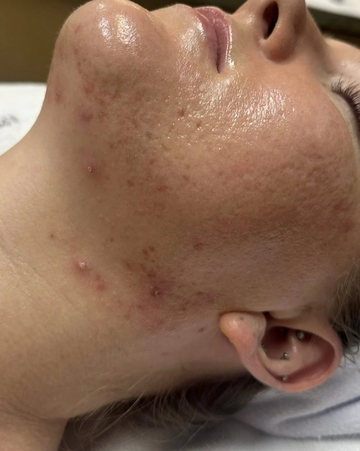 Client skin with active acne before a chemical peel series