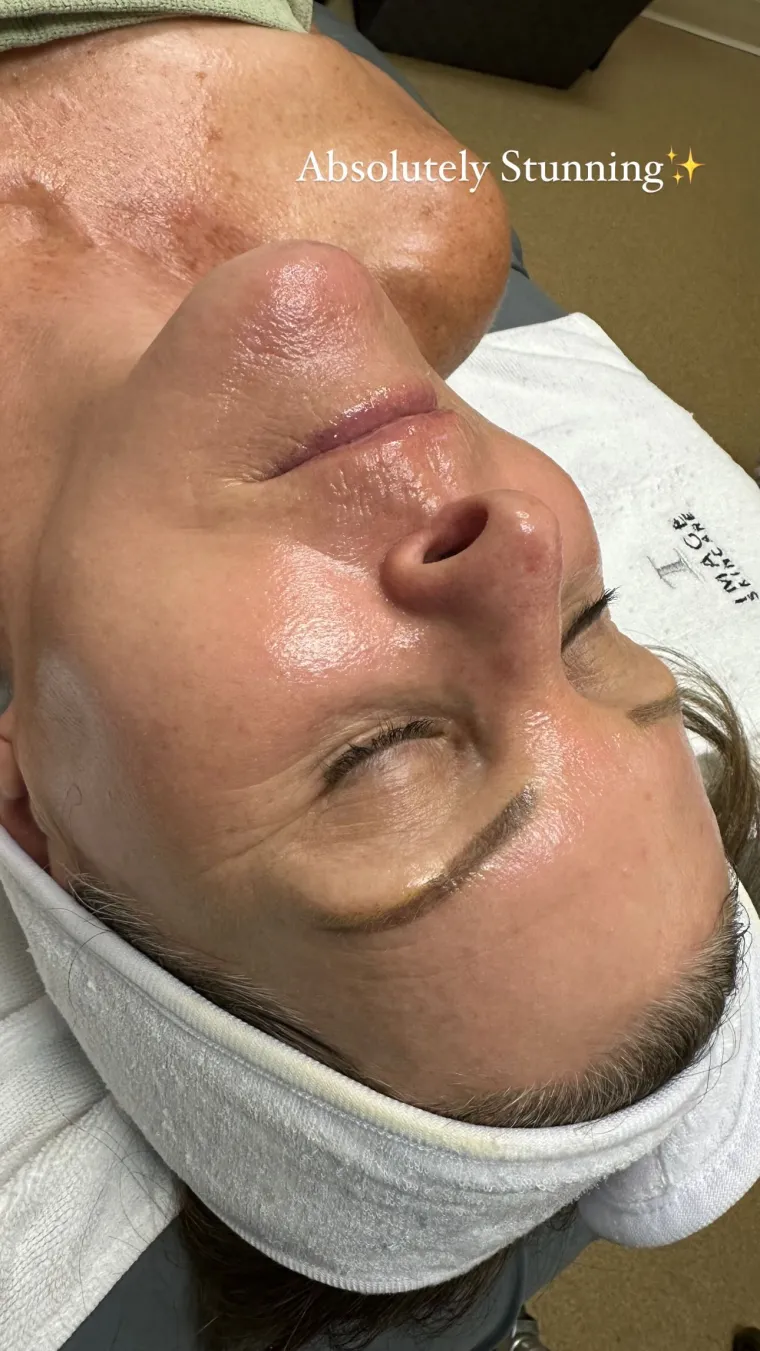 Glowing, radiant skin after a dermaplaning treatment