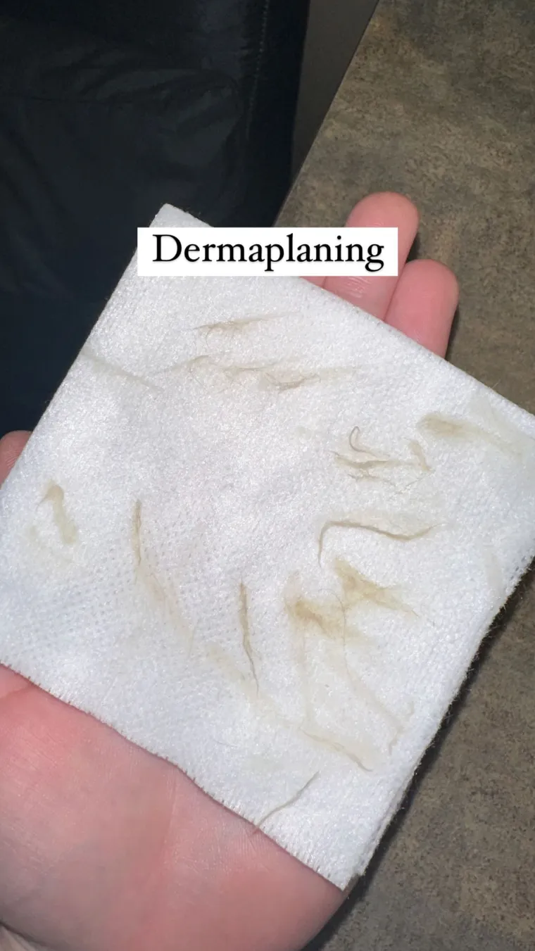 Vellus hair (peach fuzz) removed during a dermaplaning treatment