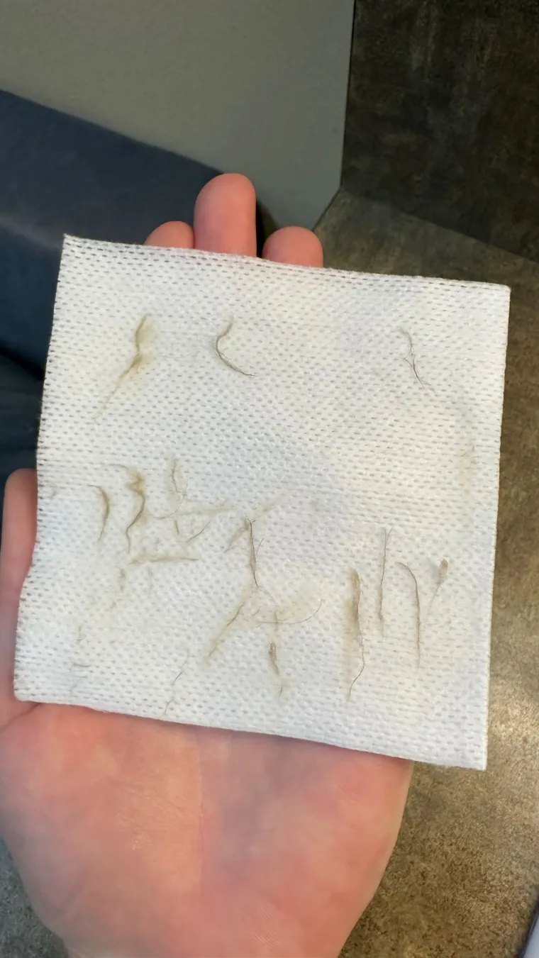 Dead skin cells and fine hair lifted away during dermaplaning