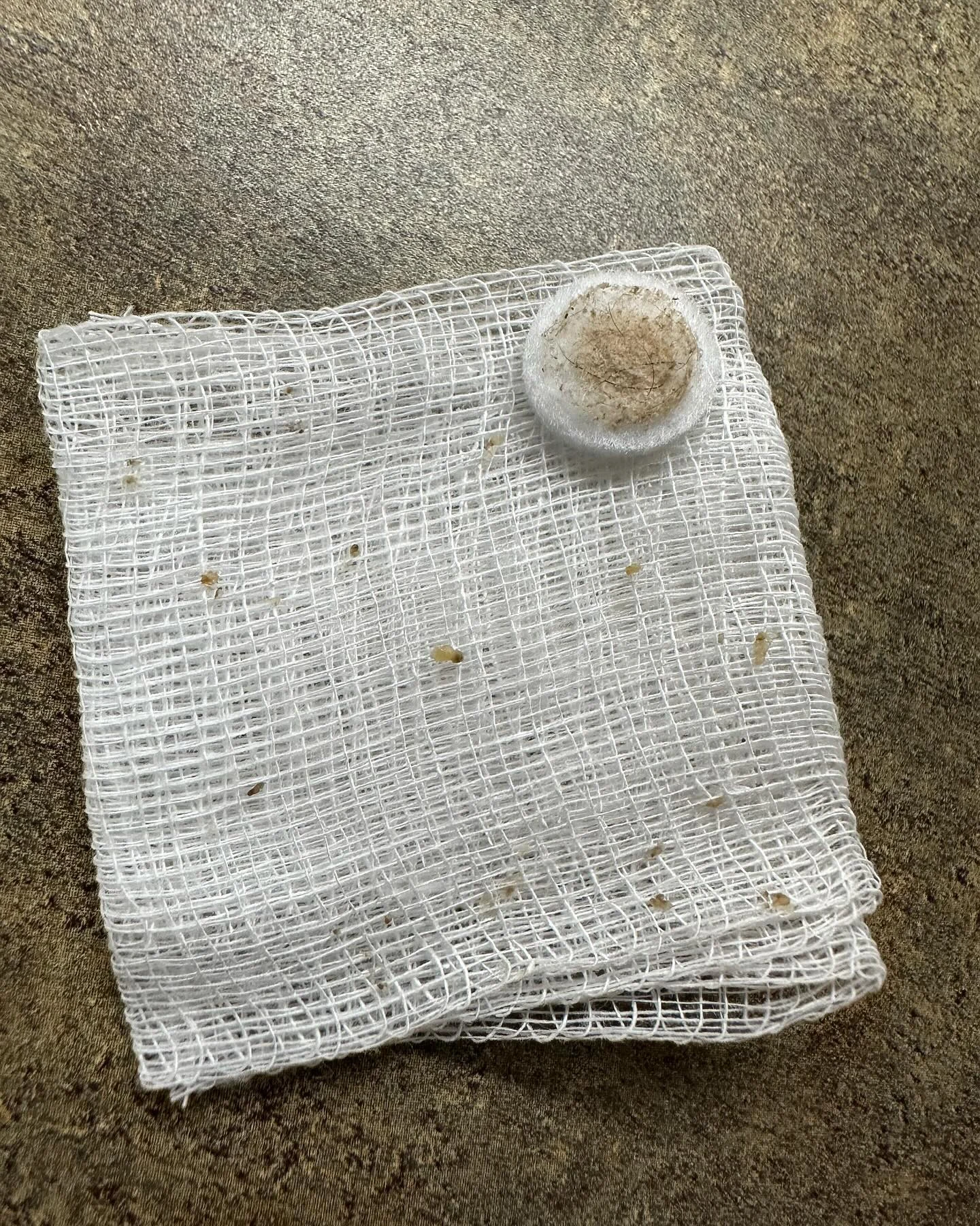 Extractions performed during a microdermabrasion facial