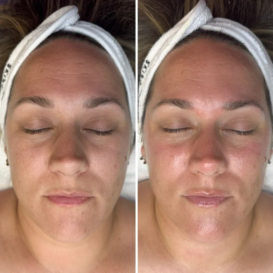 O2 Lift oxygen facial before and after results