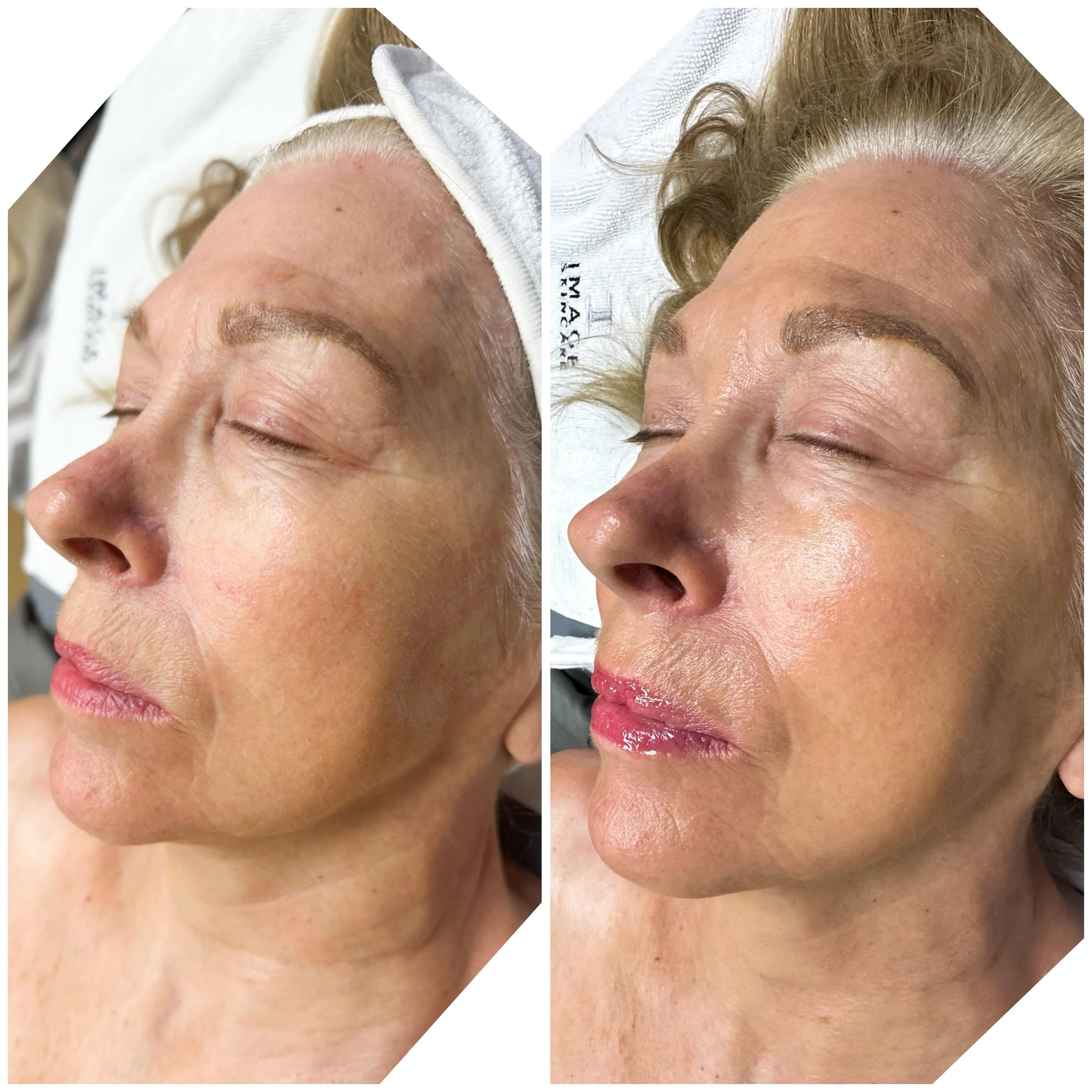 Ormedic Lift peel before and after — brighter, more even, hydrated skin