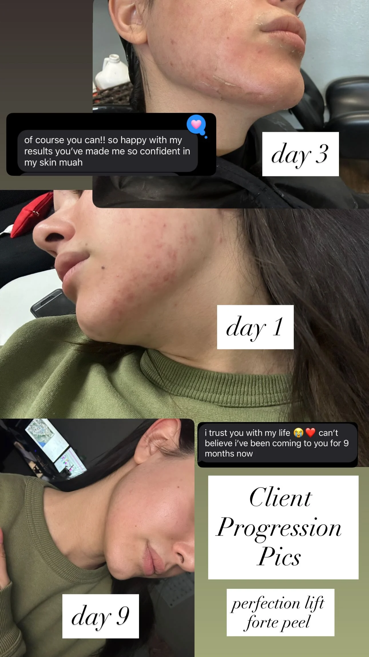 Client acne progression over several treatments with the Perfection Lift Forte peel