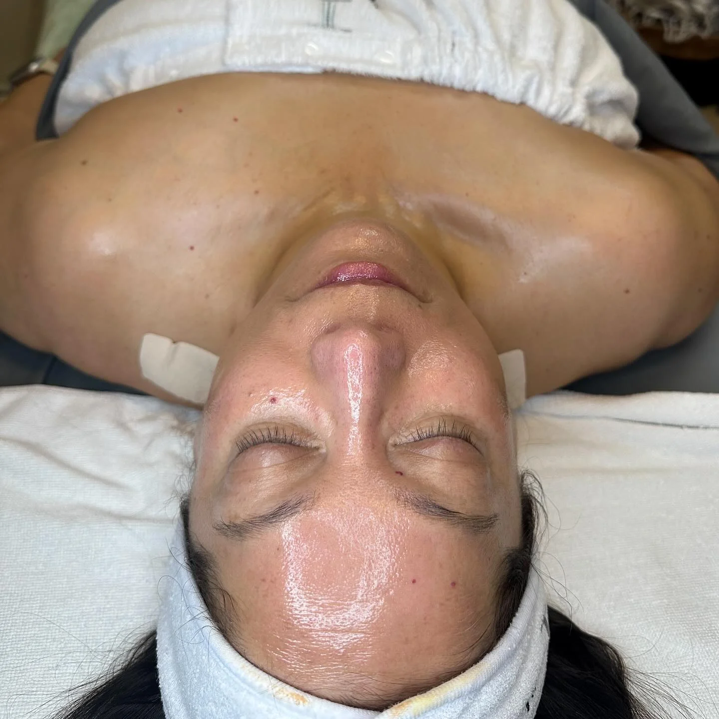 Client result after a Perfection Lift Forte peel