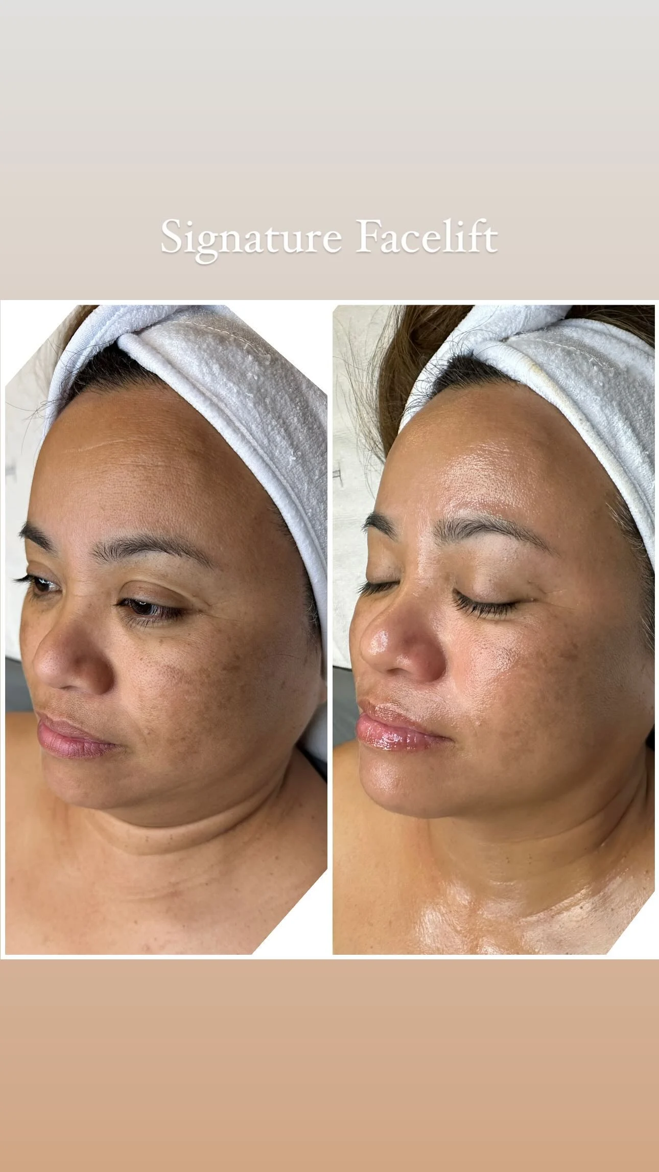 Signature Facelift peel before and after — refreshed, glowing skin