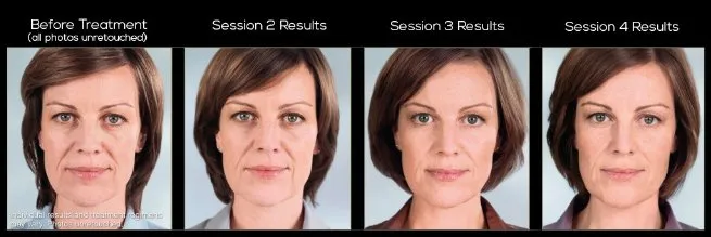 Sculptra Aesthetic Treatment