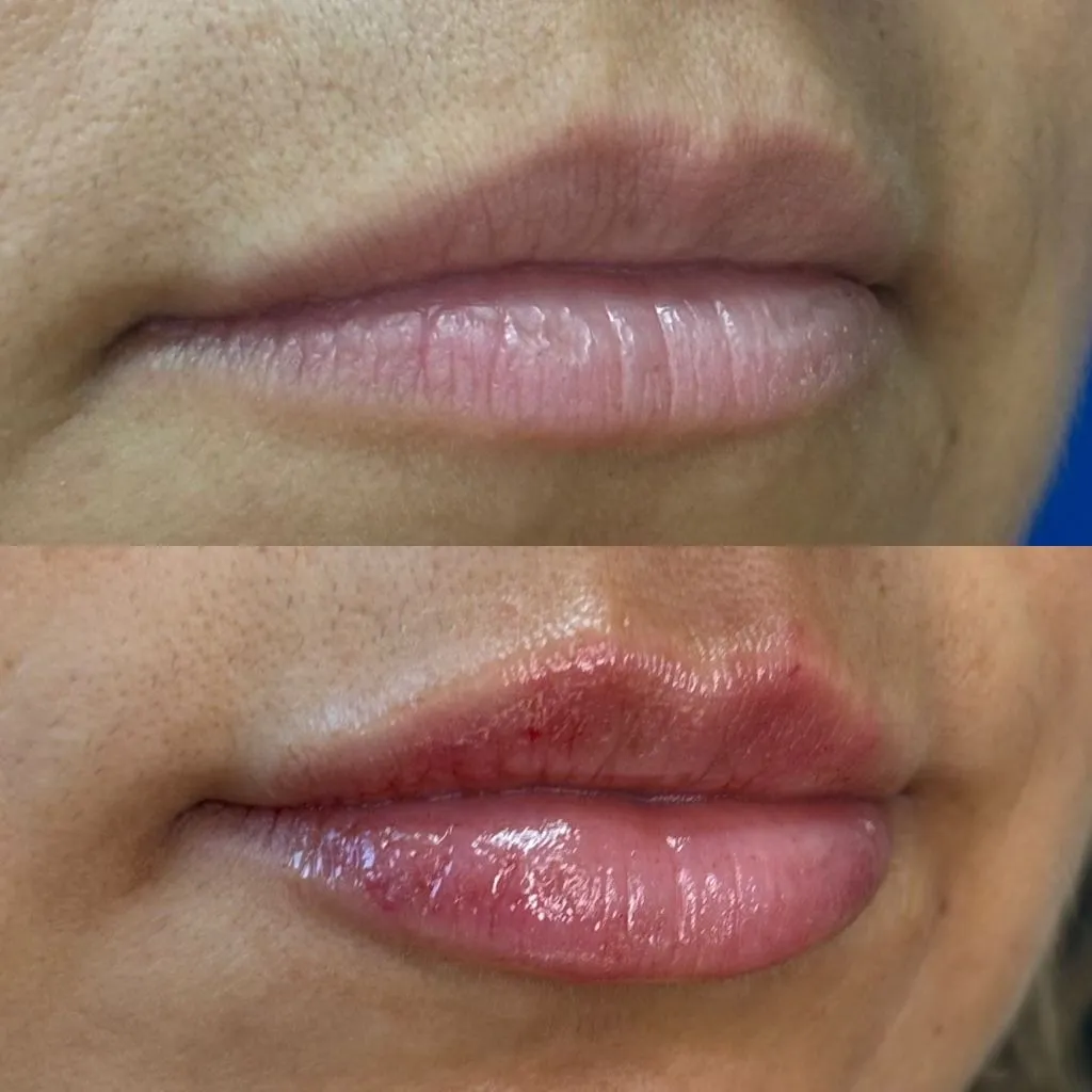 Restylane Treatment Results
