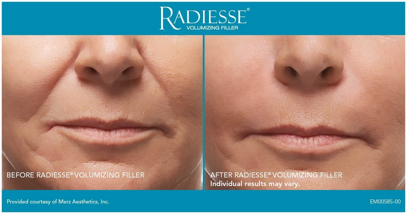 Radiesse Before and After