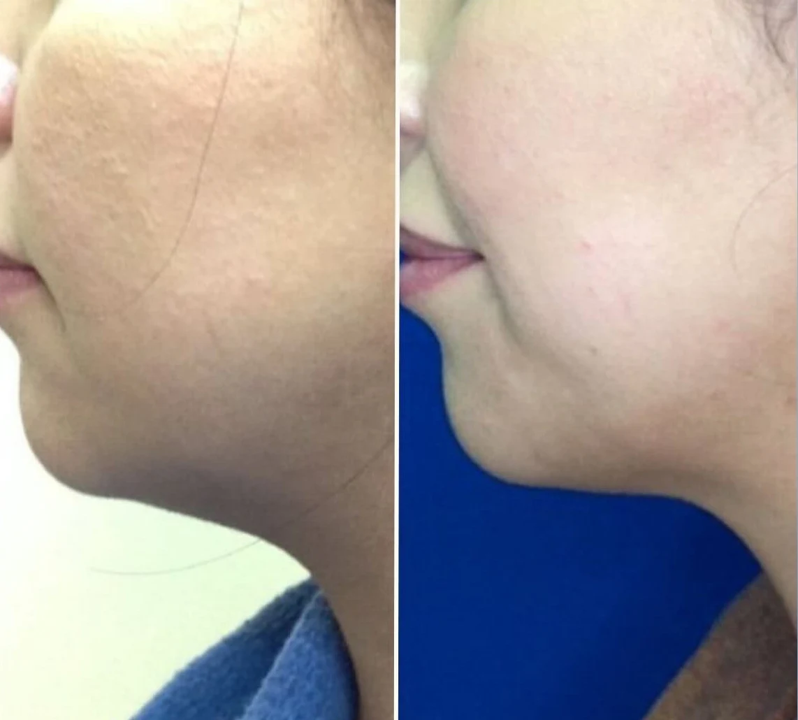 Kybella Injection before and after result