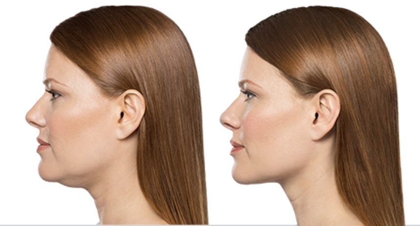 Kybella Double Chin Treatment