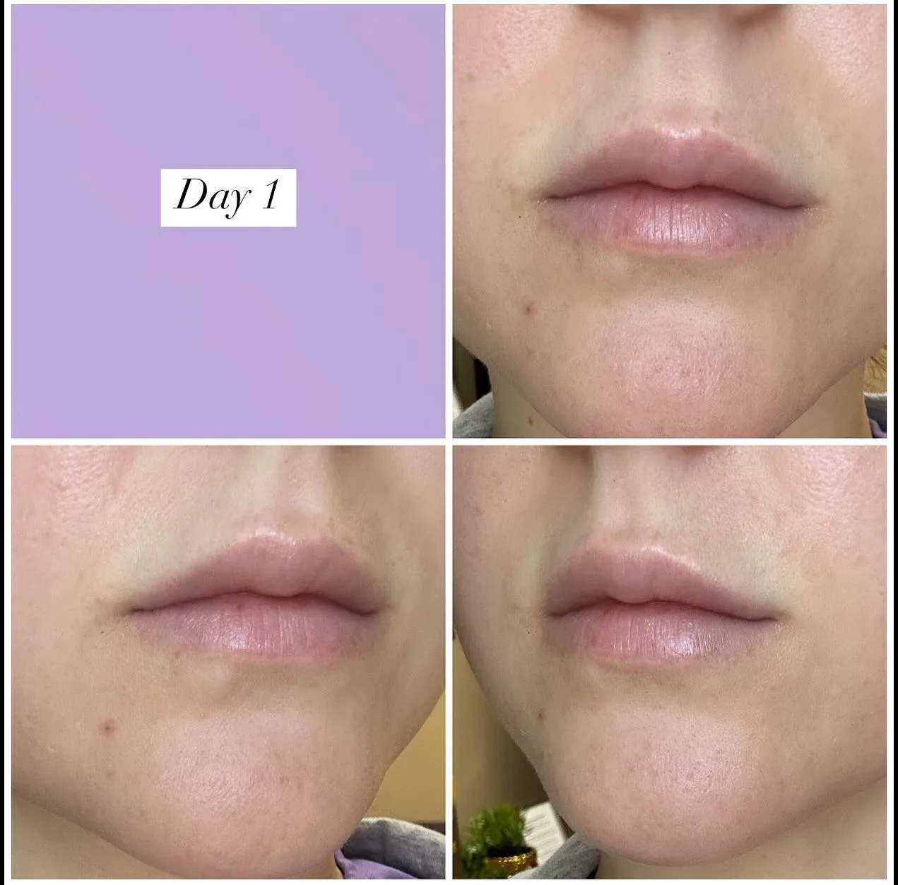 Lip filler healing progression — Day 1 after treatment