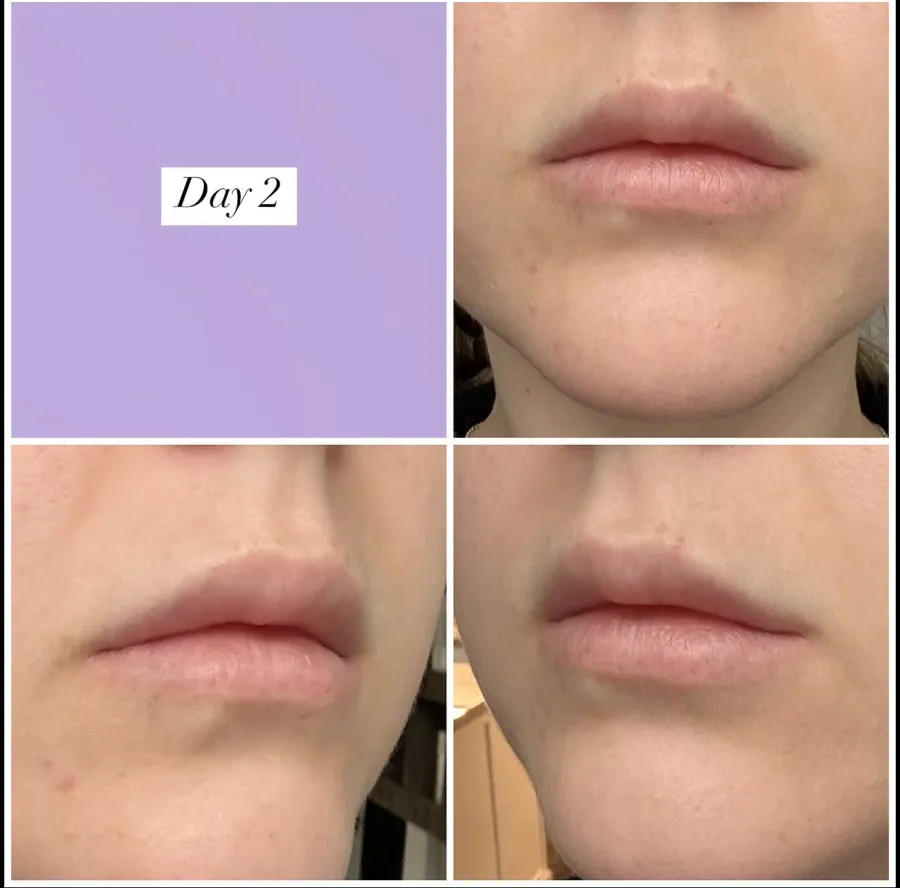Lip filler healing progression — Day 2 after treatment