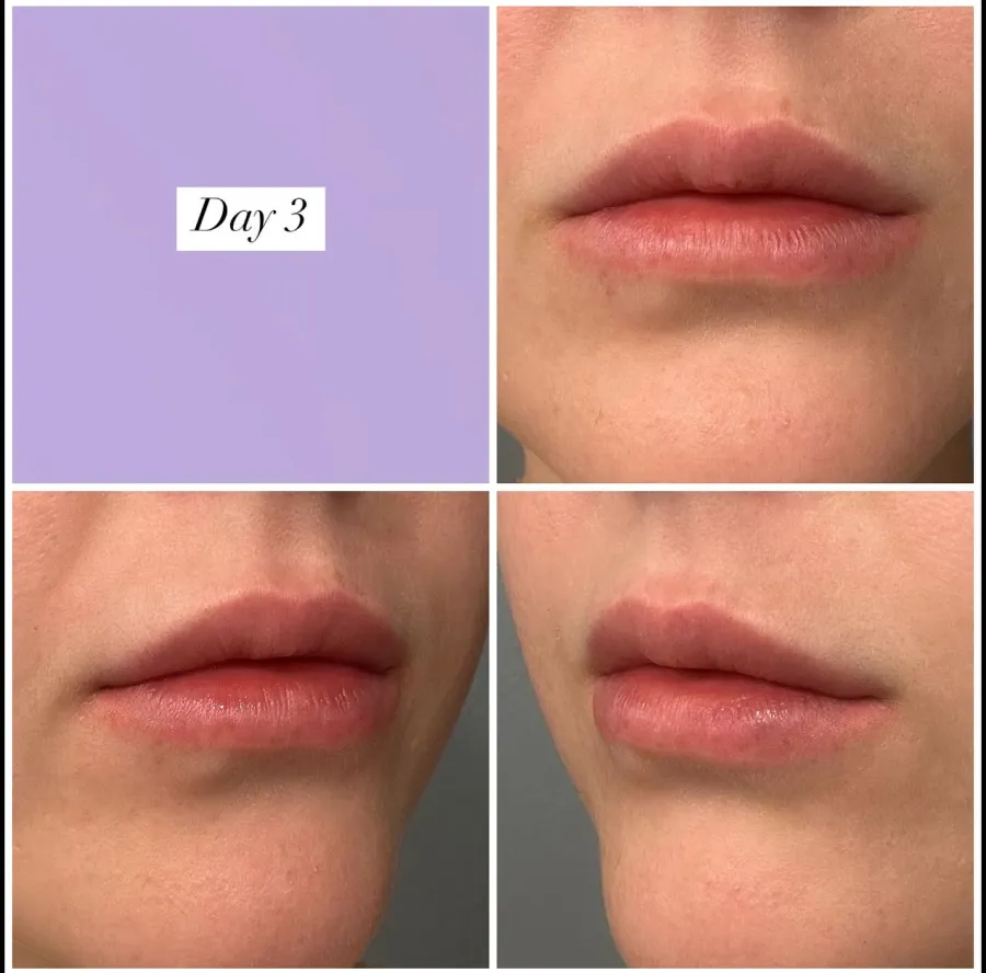 Lip filler healing progression — Day 3 after treatment