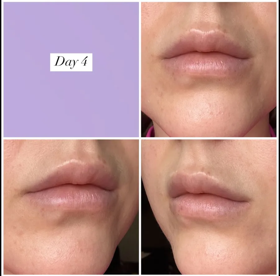 Lip filler healing progression — Day 4 after treatment