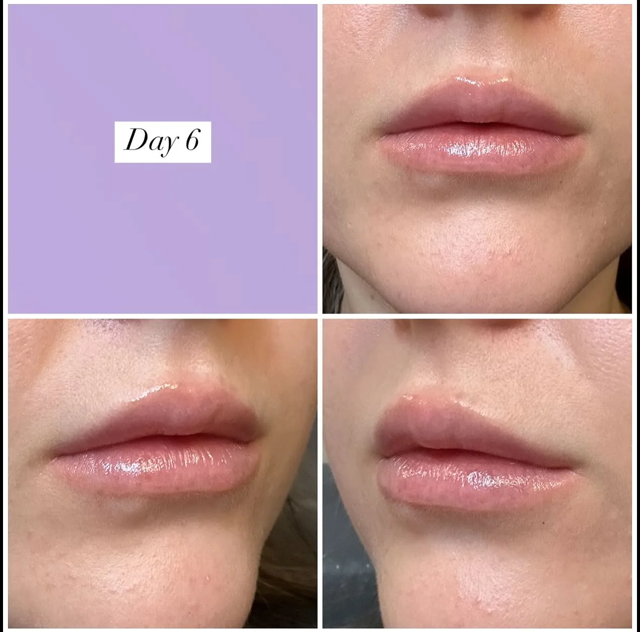 Lip filler healing progression — Day 6 after treatment