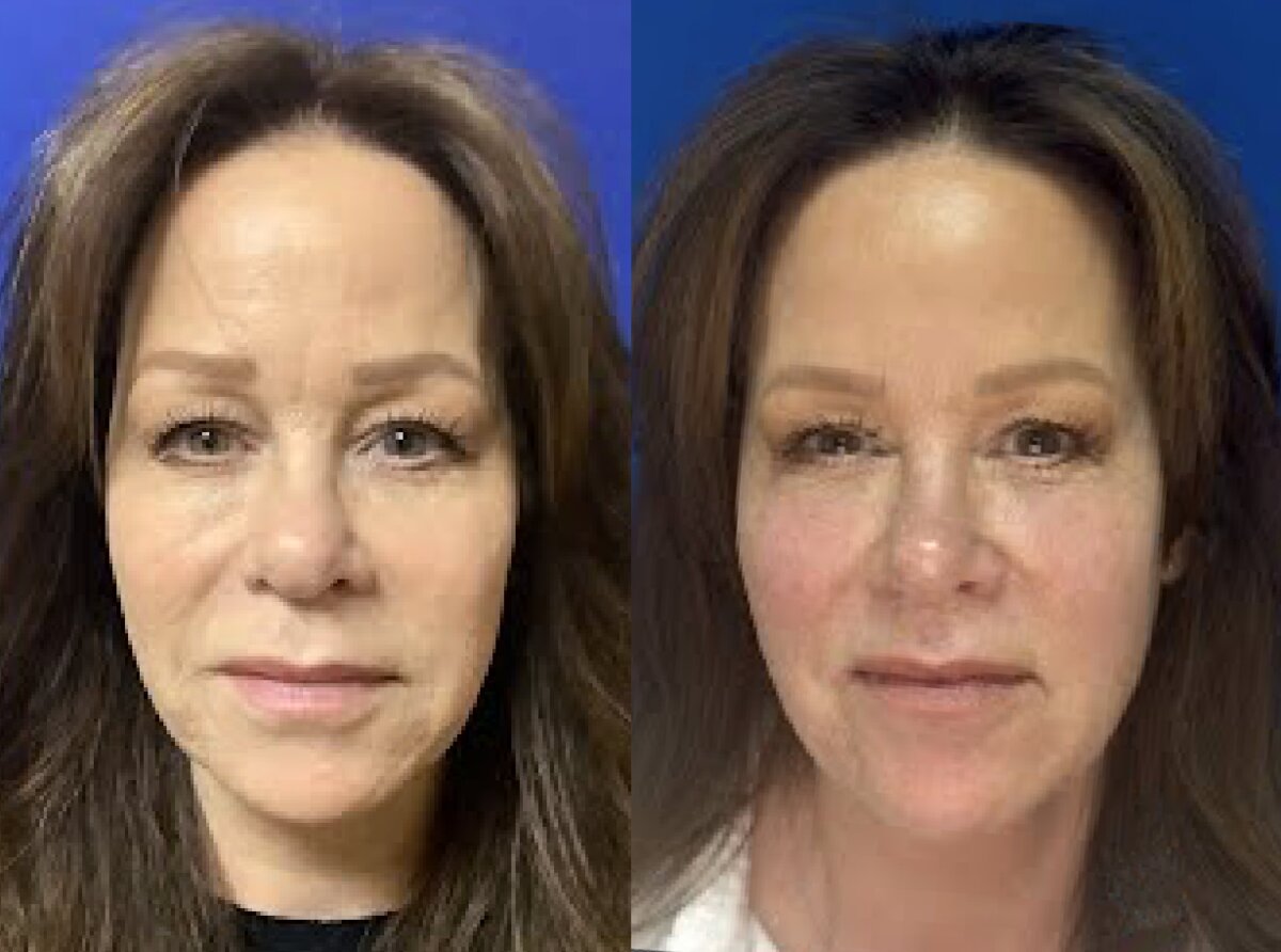 Sculptra Aesthetic Before and After Results