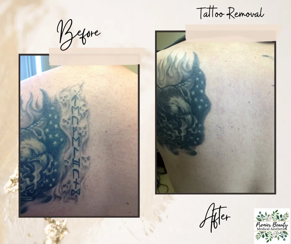 Tattoo Removal