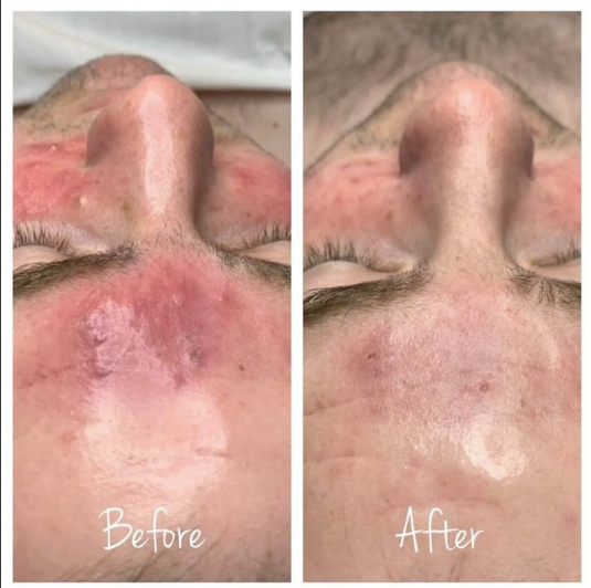 Acne peel grades III-IV treatment before and after showing improved acne
