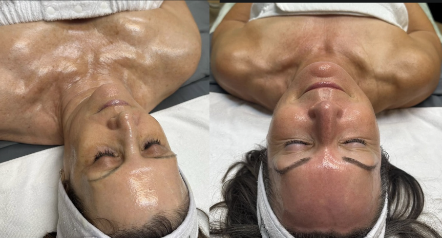 A-PEELE chemical peel treatment products