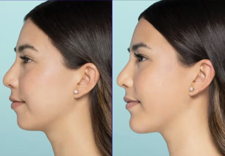 Chin augmentation before and after showing improved chin projection
