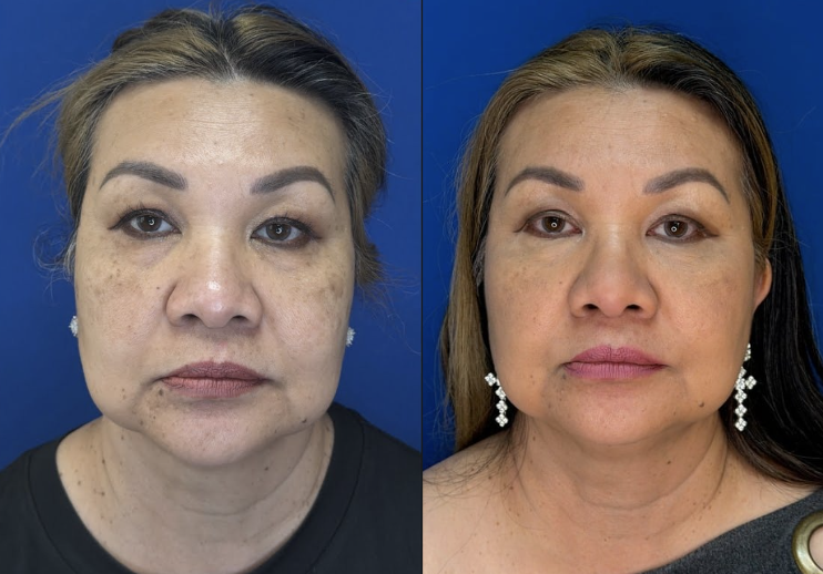 Derma PRP treatment before and after showing natural undereye improvement