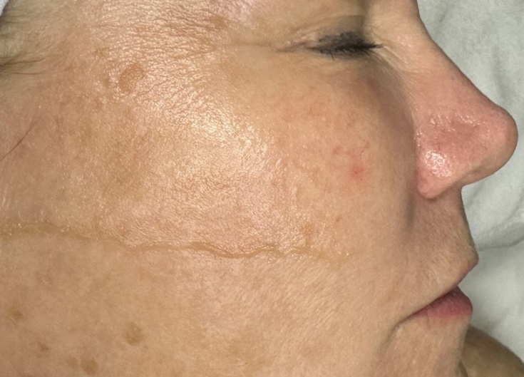 Dermaplaning treatment showing smooth, glowing skin