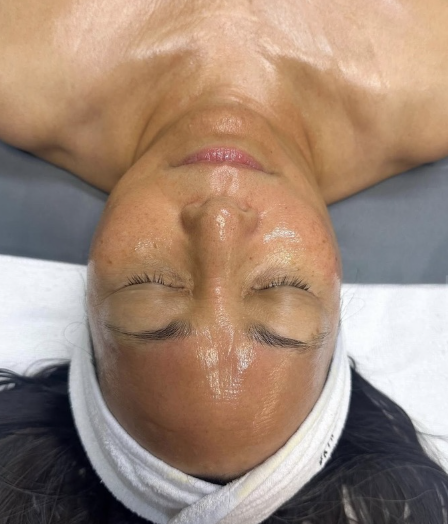 Perfection life forte peel facial treatment products