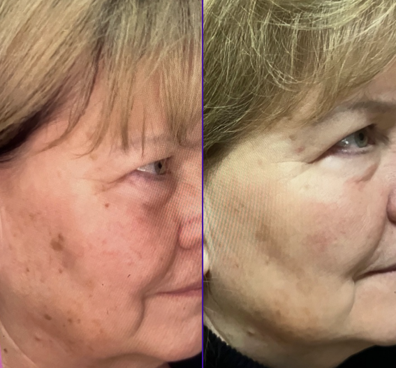 Icon IPL treatment showing skin texture improvement