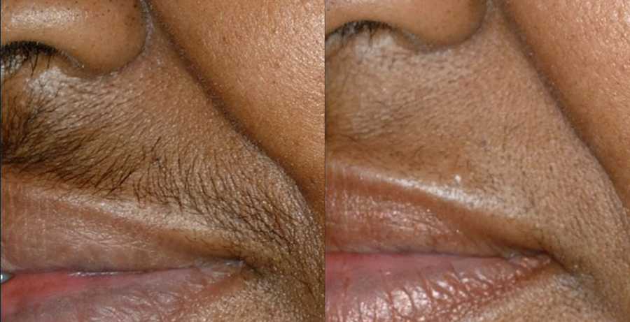 Laser hair removal treatment in progress