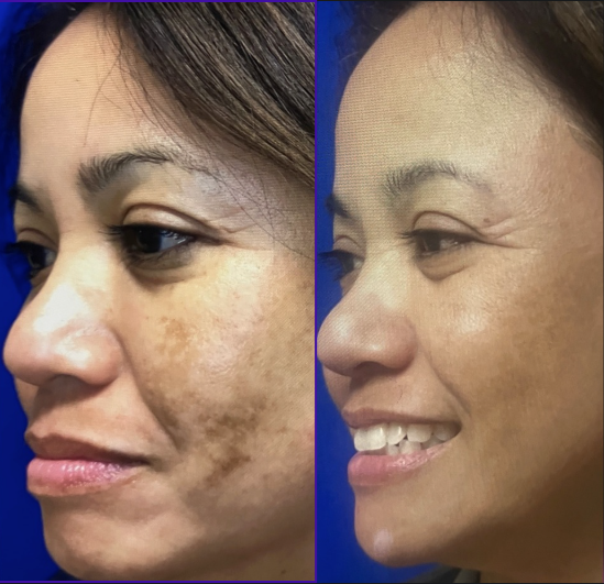 Laser treatment before and after comparison showing improved skin pigmentation