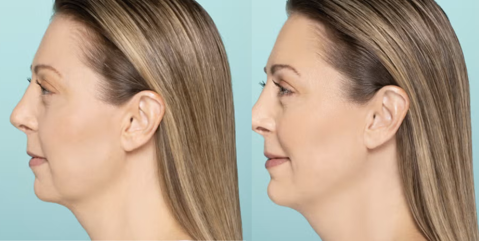 Jawline treatment showing improved definition and contour