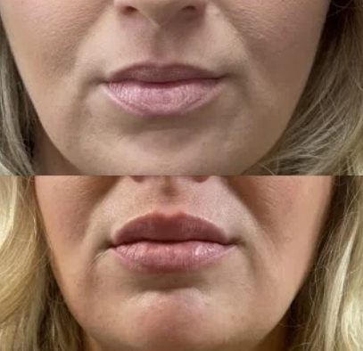 Lip filler treatment before and after showing enhanced lip volume