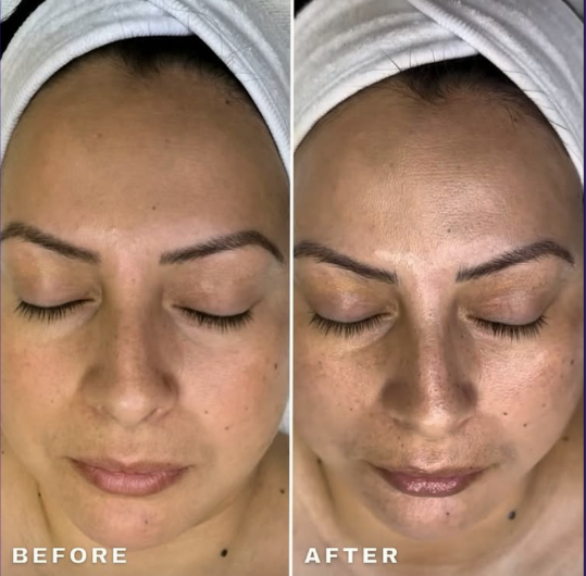 Microdermabrasion treatment before and after comparison