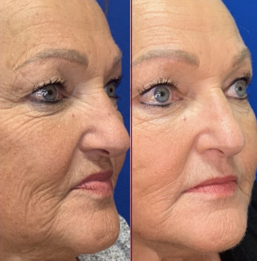 PDO threadlift treatment showing facial profile improvement