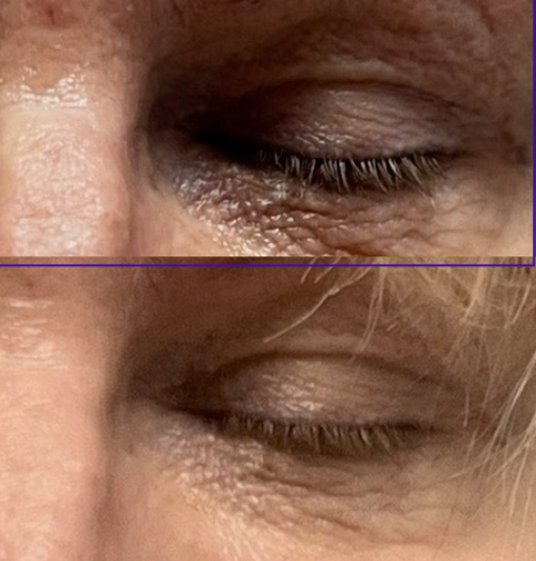 Opus stamping treatment before and after showing eye area improvement