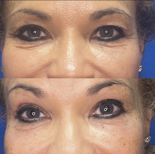 Pelleve treatment before and after showing tightened eyelid skin