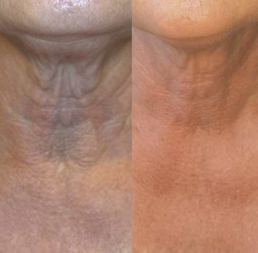 Potenza microneedling treatment before and after showing skin texture improvement